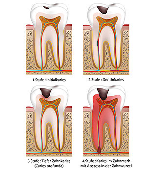 Kariesbehandlung