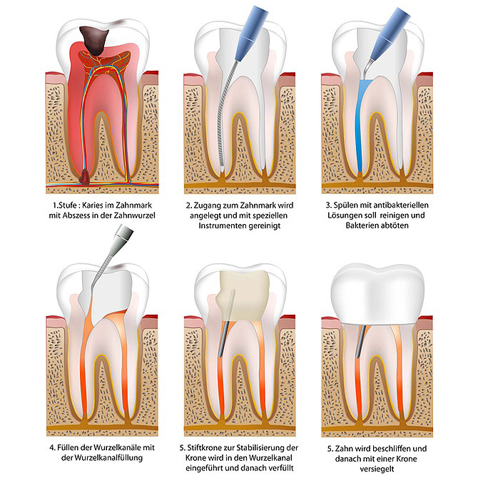 Zahnwurzelbehandlung