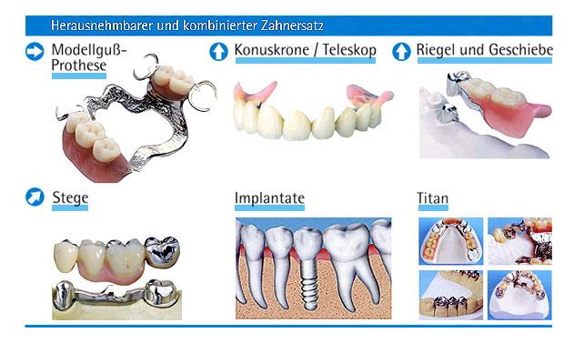 Zahnersatz